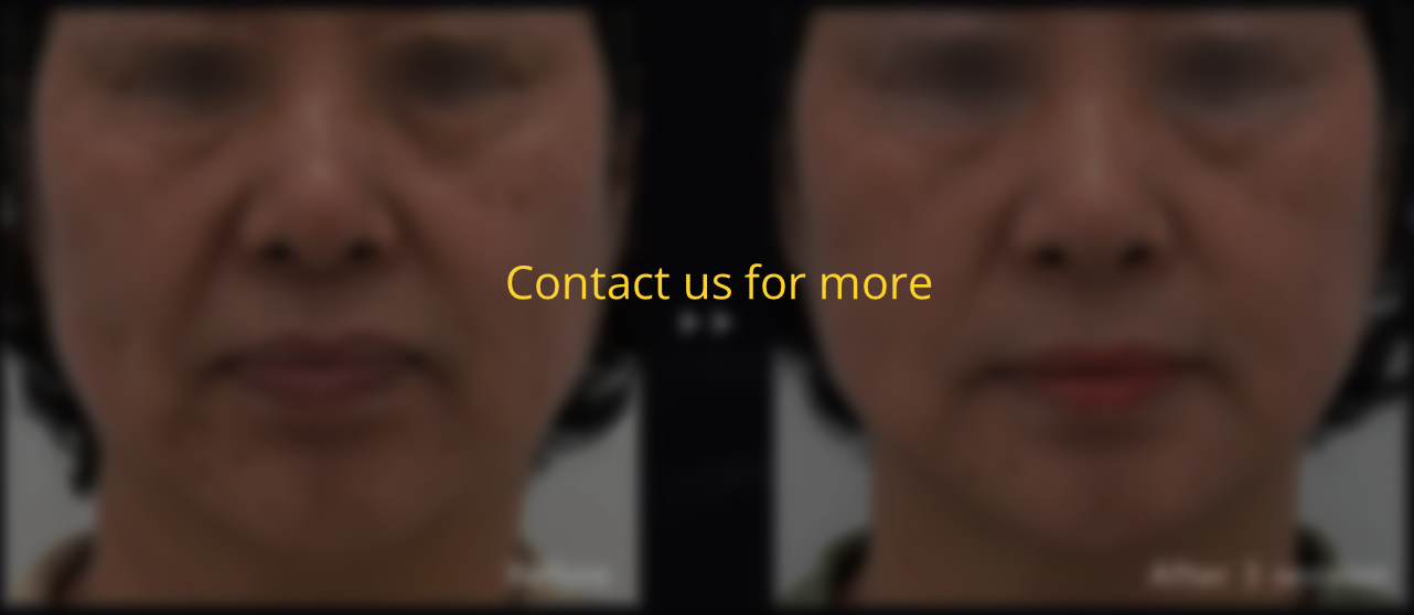 ino2